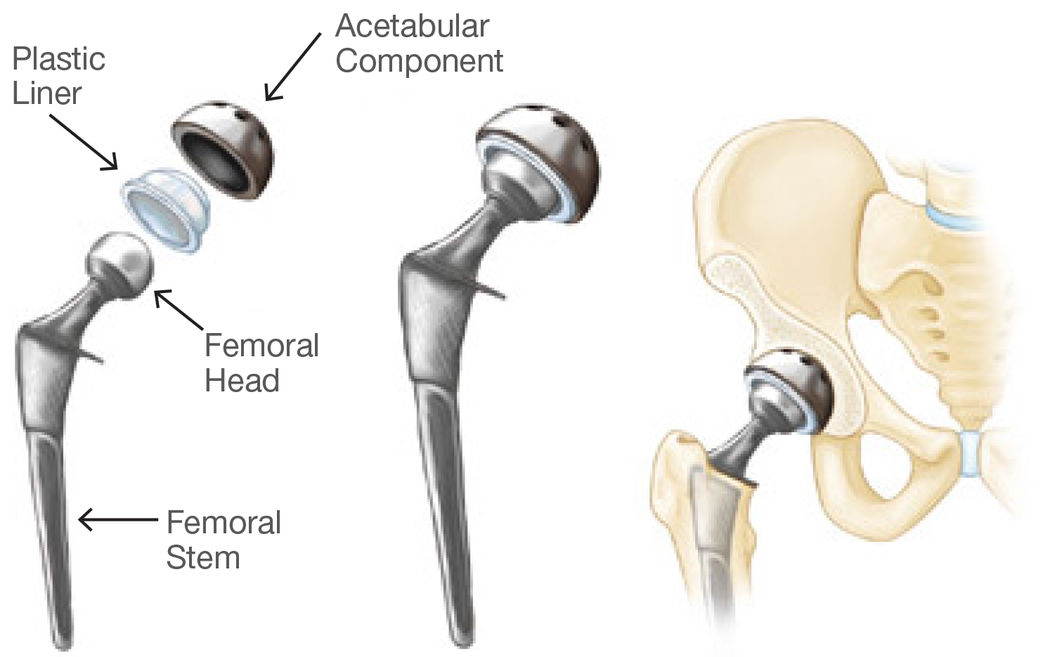 what-are-the-risks-of-hip-surgery